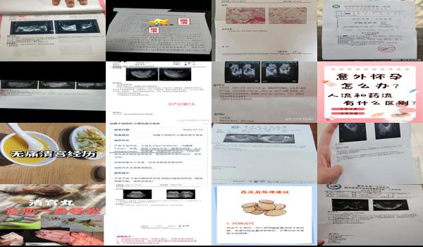  清宫不干净对下次怀孕有影响吗 - 汕头清宫不干净导致不孕